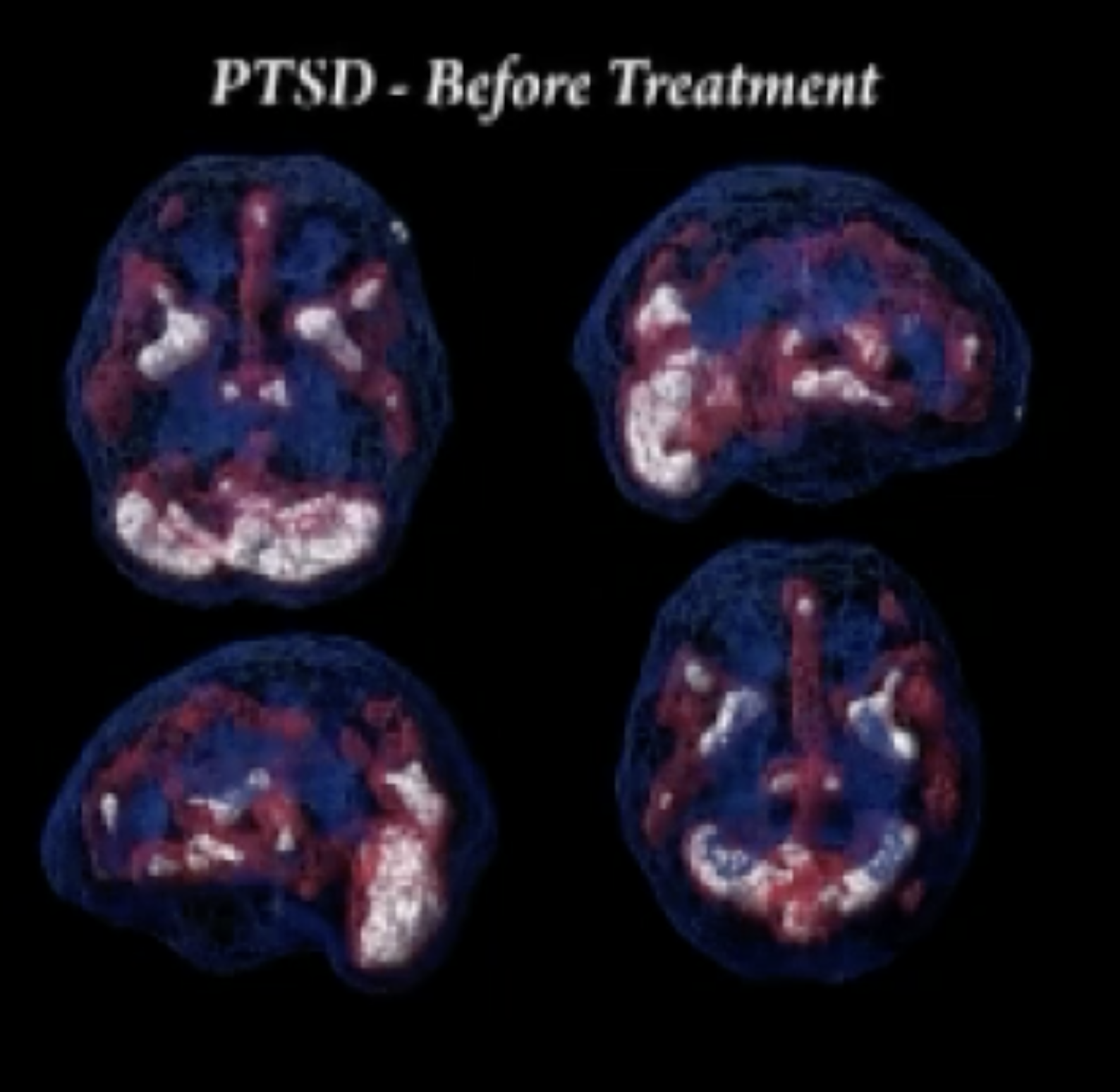 Bio-Resonance Healing: PTSD Recovery & Wellness 