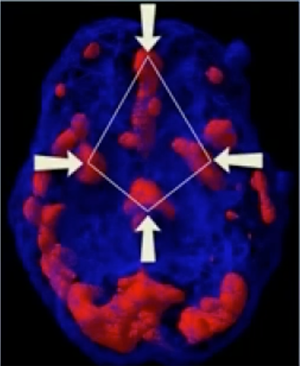 When Your Brain is on Fire: Understanding the “Diamond Pattern” of PTSD and Why Talk Therapy Isn’t Enough